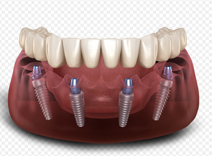 Réhabilitation Full-Arch sur Implants